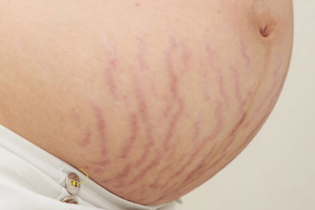 3 cách chữa rạn da cho bà bầu