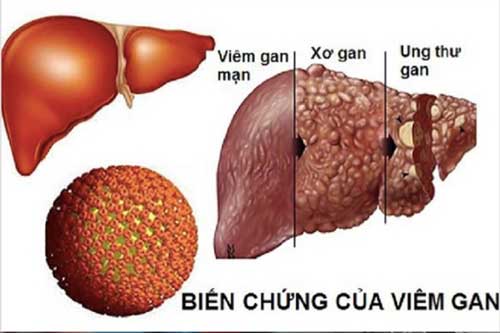 7 loại viêm nhiễm không nên coi thường vì dễ dẫn đến ung thư