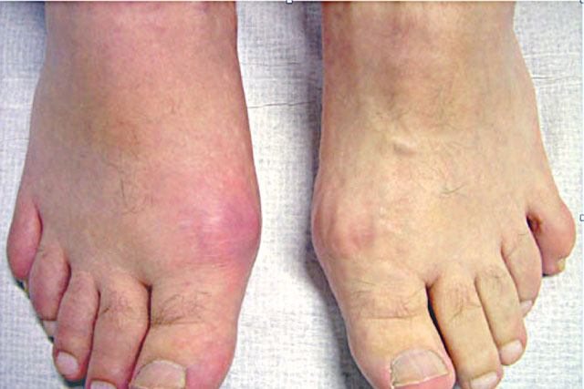 Thực phẩm người bị bệnh Gout không nên ăn