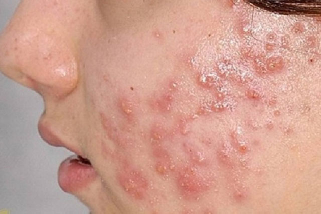 3 cách trị mụn trứng cá vô cùng đơn giản