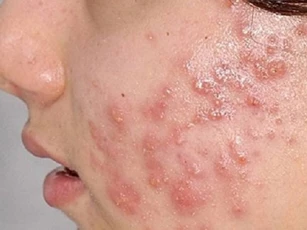 3 cách trị mụn trứng cá vô cùng đơn giản