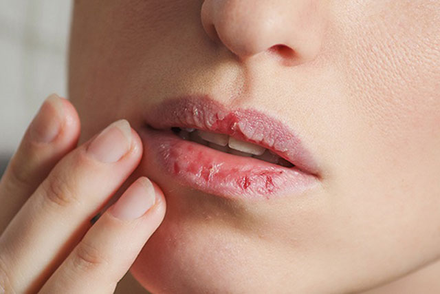Giải quyết dứt điểm tình trạng môi khô