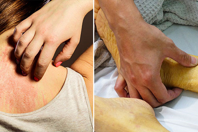 Dấu hiệu của ung thư tuyến tụy bạn không được chủ quan