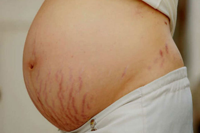 3 cách trị rạn da ai cũng có thể thực hiện