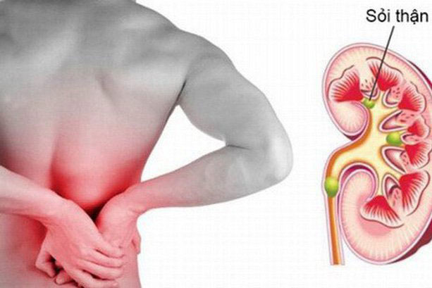 Dấu hiệu cảnh báo thận đang có sỏi