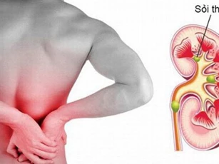 Dấu hiệu cảnh báo thận đang có sỏi