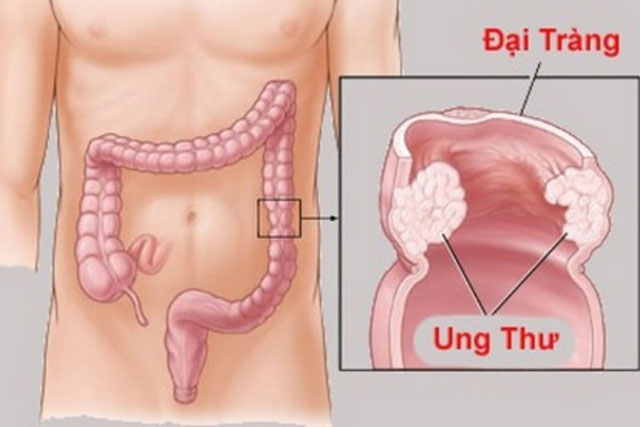 Dấu hiệu cảnh báo bệnh ung thư trực tràng