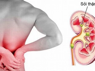 Dấu hiệu cảnh báo thận đang có sỏi