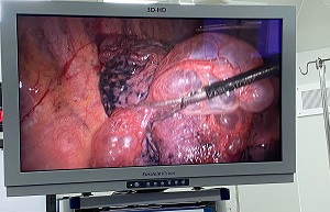 Phẫu thuật nội soi 3D cắt kén phổi cứu người bệnh thoát "cửa tử"