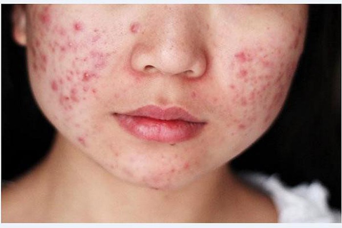 Mách bạn 3 cách chữa mụn trứng cá tại nhà hiệu quả nhất