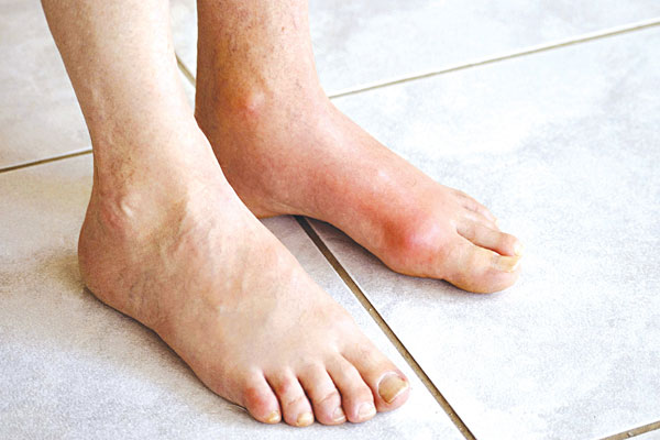 Những người mắc bệnh gout nên ăn thực phẩm gì?