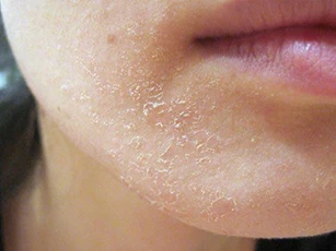 Điều bạn tuyệt đối không làm khi bị khô da