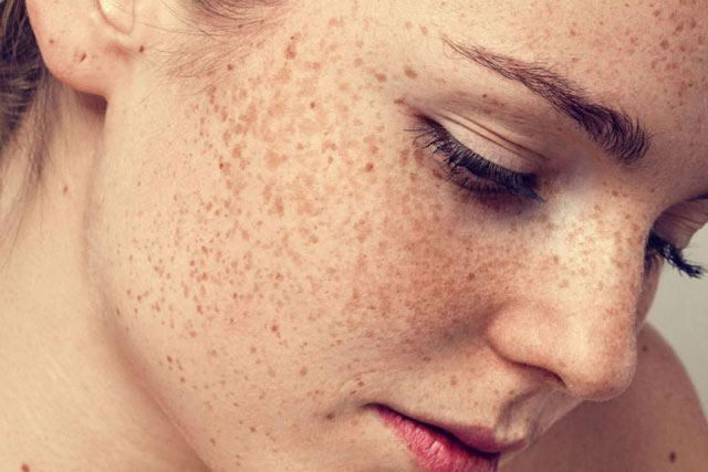 2 công thức trị tàn nhang rất đơn giản