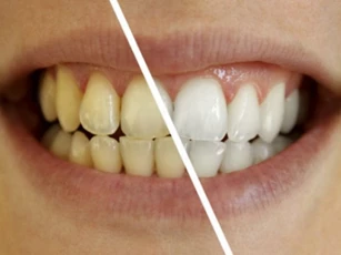 Cách đơn giản để giải quyết răng ố vàng bạn phải biết