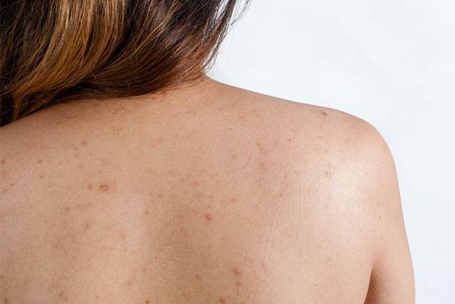 4 loại nước tắm vào sạch mụn, hết viêm lỗ chân lông