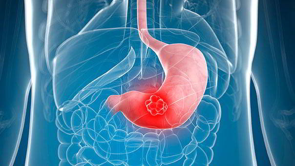 Dấu hiệu cảnh báo bệnh ung thư dạ dày