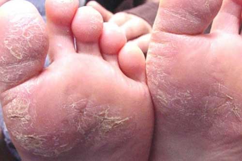 Nếu thấy bàn chân có dấu hiệu này đi khám ngay kẻo hối không kịp