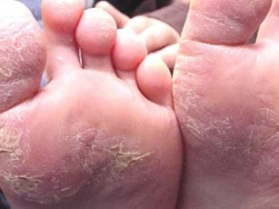 Nếu thấy bàn chân có dấu hiệu này đi khám ngay kẻo hối không kịp