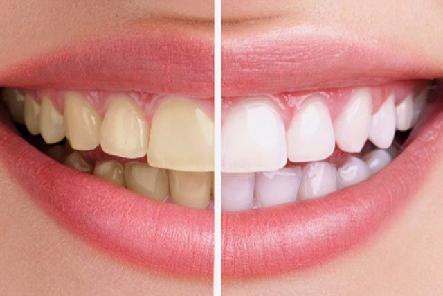 3 công thức tẩy trắng răng tại nhà đơn giản có thể bạn chưa biết