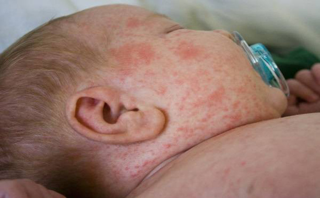 3 mẹo dân gian giúp bạn trị rôm sảy cho bé trong mùa hè