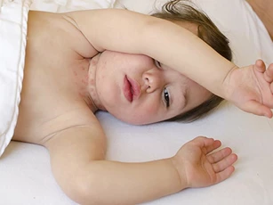 Cách xử lý khi bé bị hăm cổ