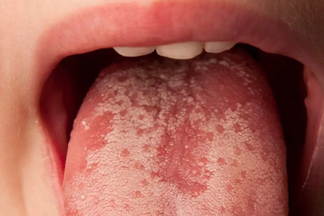 Đốm trắng trên lưỡi có thể là dấu hiệu của những điều này