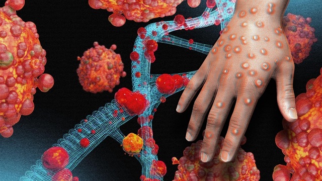 Quyết liệt ngăn chặn bệnh đậu mùa khỉ