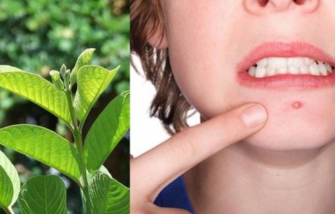 Trị mụn trứng cá trong mùa hè với lá ổi