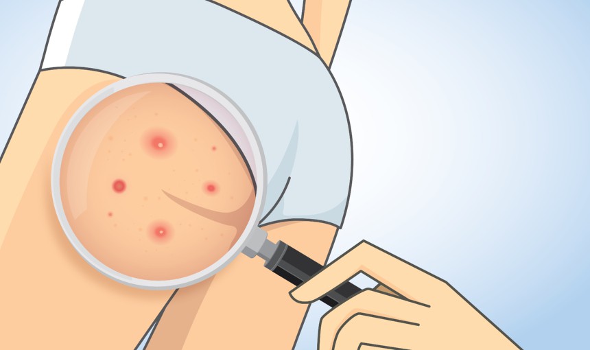 Bí quyết để cả mùa hè mà vòng 3 không hề bị mụn