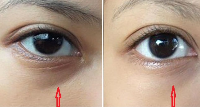 3 cách chữa thâm mắt vô cùng đơn giản