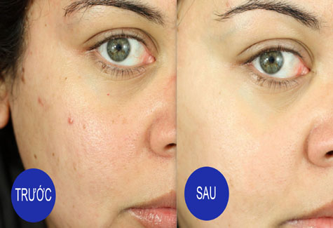 5 cách trị mụn trứng cá đơn giản có thể bạn chưa biết