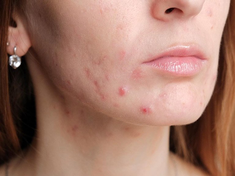 Điều cần lưu ý khi bị mụn trứng cá đỏ