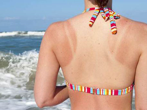 Bạn đã biết cách để làn da không bắt nắng?