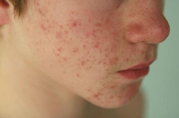 2 loại cây ai cũng mua được có tác dụng trị mụn 'thần tốc'