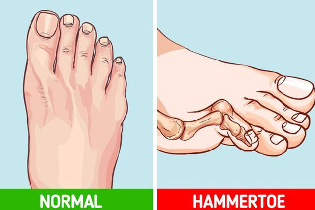 Tác hại khôn lường khi mang giày cao gót hàng ngày