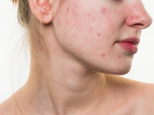 5 vấn đề về da bạn thường gặp phải trong mùa hè