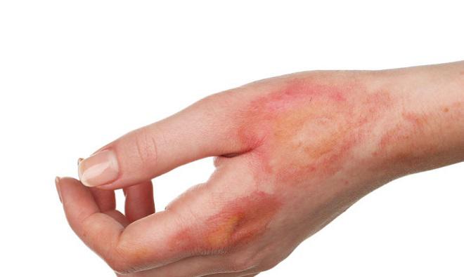 Những cách trị vết bỏng để không bị sẹo