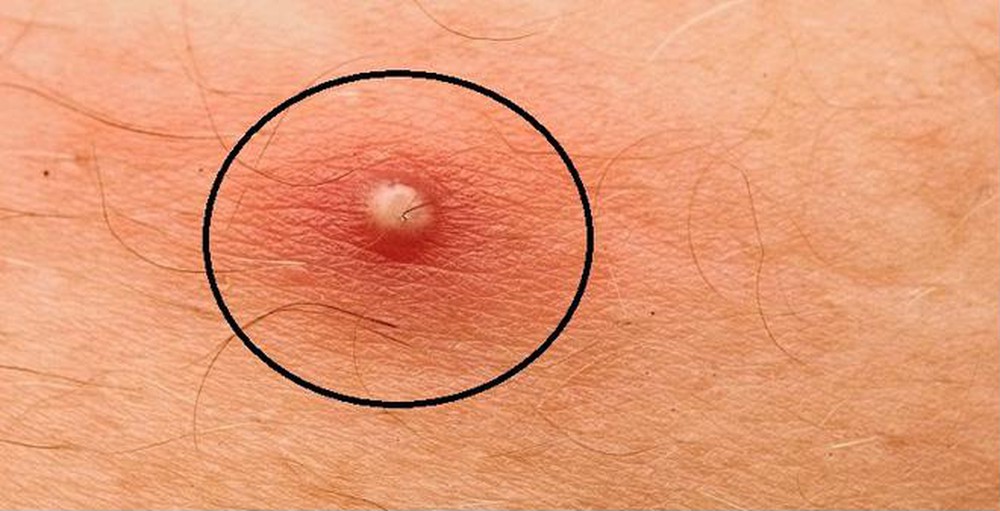 4 cách chữa mụn nhọt đơn giản nhưng bạn chưa biết