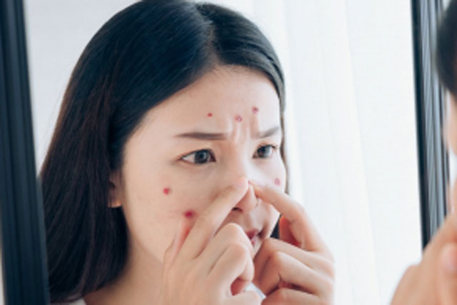 5 cách ngừa thâm dành cho nàng nghiện nặn mụn