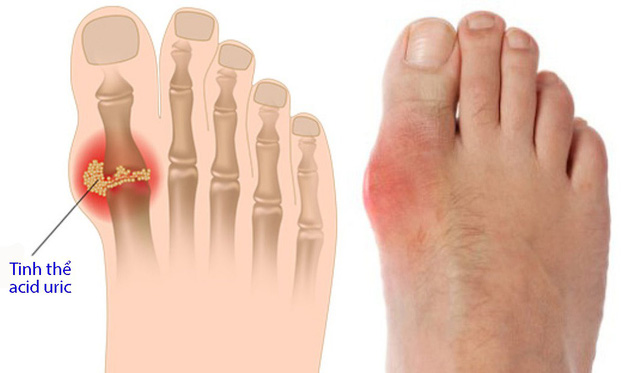 Không muốn bị bệnh gout thì hãy hạn chế thực phẩm này