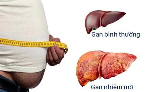 gan nhiễm mỡ 