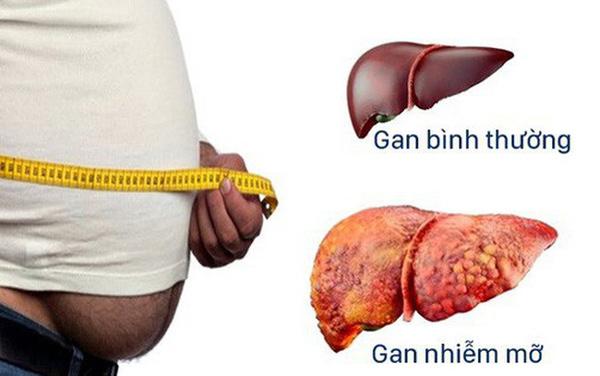 4 biểu hiện bệnh gan nhiễm mỡ bạn phải biết
