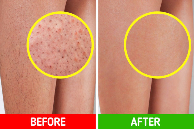 6 cách tự cải thiện làn da viêm nang lông tại nhà