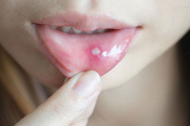 5 m&#x1EB9;o ch&#x1EEF;a nhi&#x1EC7;t mi&#x1EC7;ng hi&#x1EC7;u qu&#x1EA3; ch&#x1EC9; sau hai ng&#xE0;y m&#xE0; kh&#xF4;ng c&#x1EA7;n d&#xF9;ng &#x111;&#x1EBF;n thu&#x1ED1;c