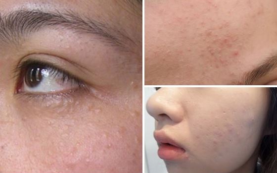 2 cách trị mụn ẩn dưới da chưa bao giờ dễ như thế