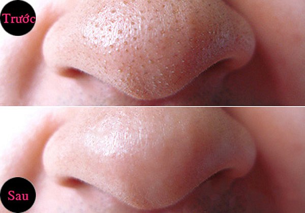 Công thức trị mụn đầu đen chỉ với mật ong và chanh