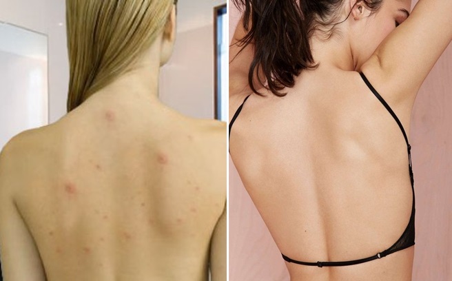 3 cách sạch mụn ở lưng vô cùng đơn giản