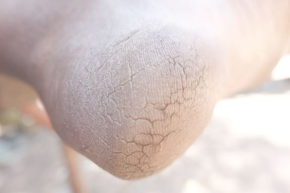 Dấu hiệu ở chân cảnh báo bạn đang bị bệnh