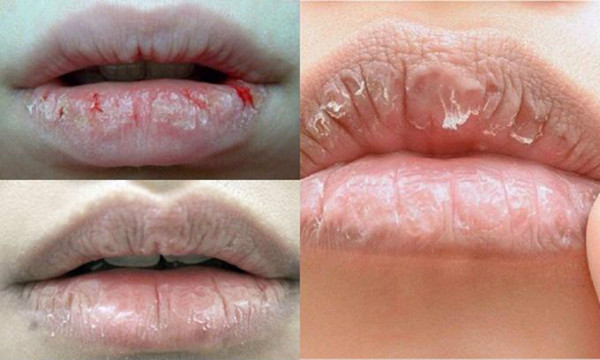 Lý do khiến môi bạn khô, nứt nẻ
