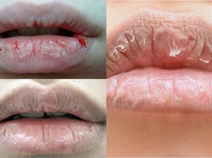 Lý do khiến môi bạn khô, nứt nẻ